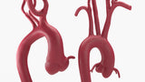 Marfanoid Aortic Root Aneurysm and Normal