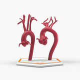 Marfanoid Aortic Root Aneurysm and Normal