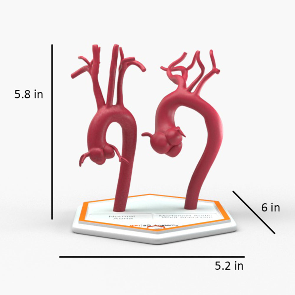 Marfanoid Aortic Root Aneurysm and Normal