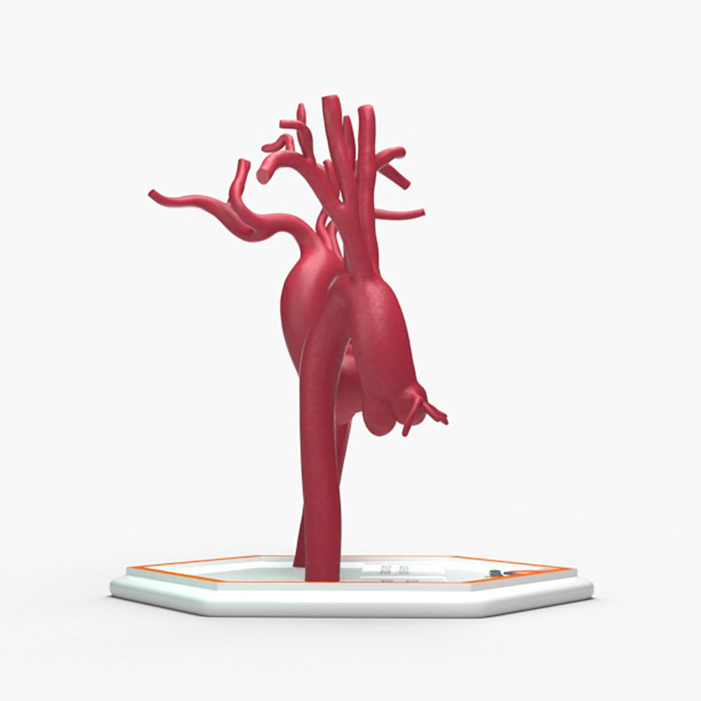 Marfanoid Aortic Root Aneurysm and Normal