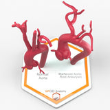 Marfanoid Aortic Root Aneurysm and Normal