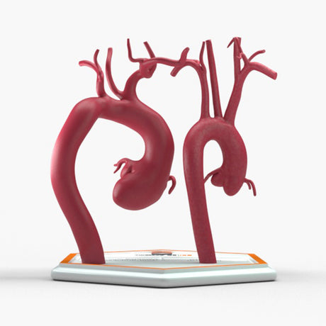 Marfanoid Aortic Root and Sinus of Valsalva Aneurysm and Normal