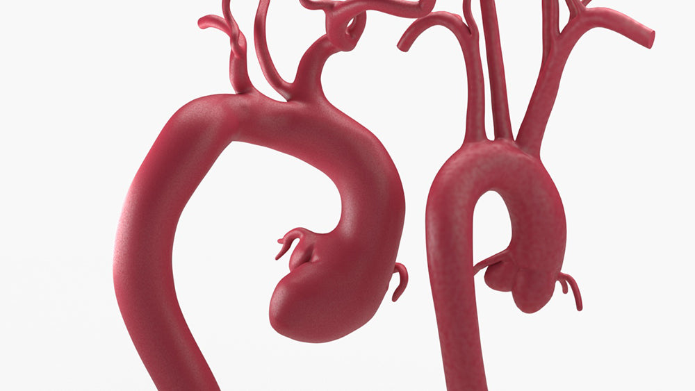 Marfanoid Aortic Root and Sinus of Valsalva Aneurysm and Normal