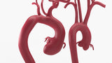 Marfanoid Aortic Root and Sinus of Valsalva Aneurysm and Normal
