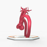 Marfanoid Aortic Root and Sinus of Valsalva Aneurysm and Normal