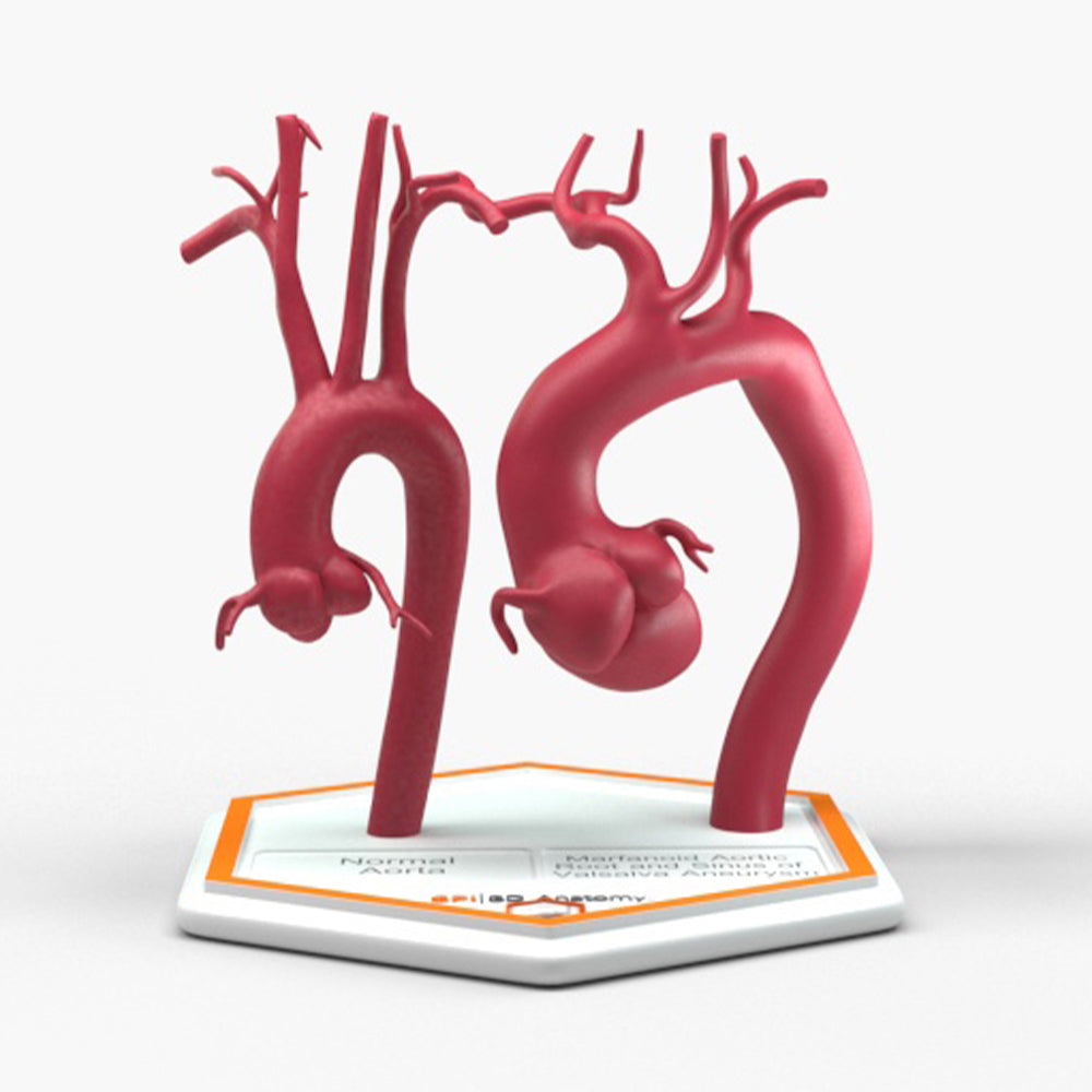 Marfanoid Aortic Root and Sinus of Valsalva Aneurysm and Normal