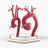 Marfanoid Aortic Root and Sinus of Valsalva Aneurysm and Normal
