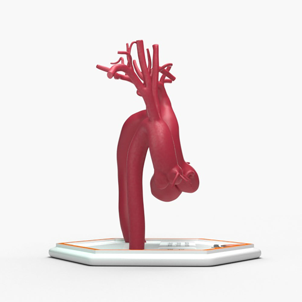 Marfanoid Aortic Root and Sinus of Valsalva Aneurysm and Normal