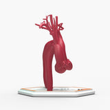 Marfanoid Aortic Root and Sinus of Valsalva Aneurysm and Normal
