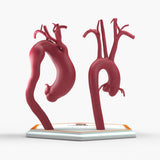 Fusiform Ascending & Descending Aortic Aneurysm 1 and Normal