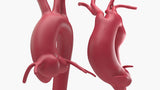 Fusiform Ascending & Descending Aortic Aneurysm 1 and Normal