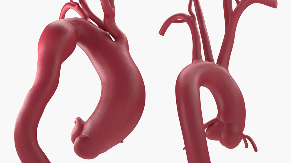 Fusiform Ascending & Descending Aortic Aneurysm 1 and Normal