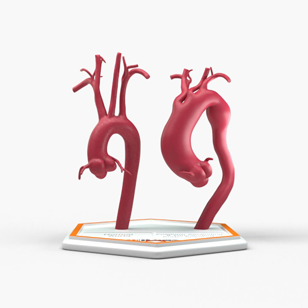 Fusiform Ascending & Descending Aortic Aneurysm 1 and Normal