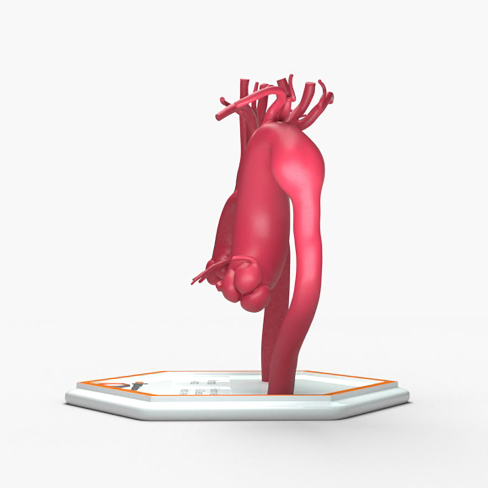 Fusiform Ascending & Descending Aortic Aneurysm 1 and Normal