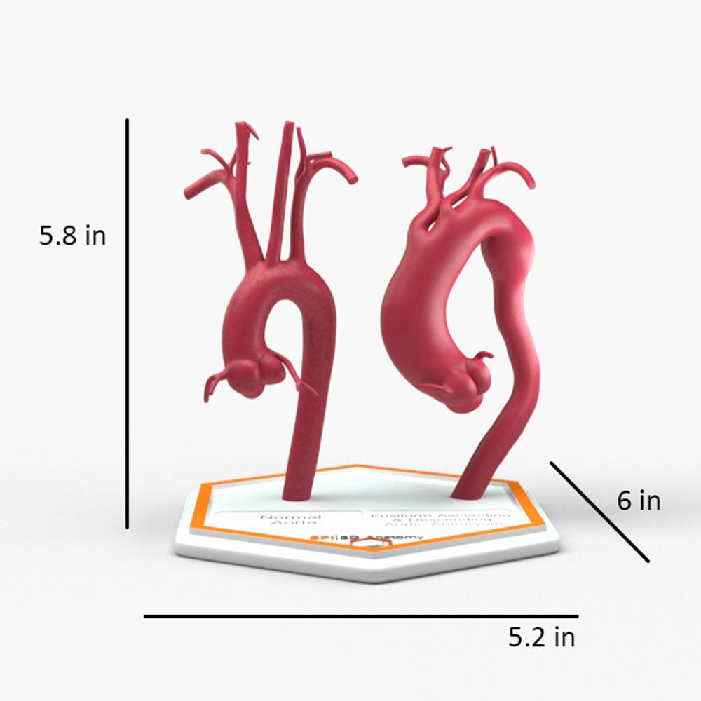 Fusiform Ascending & Descending Aortic Aneurysm 1 and Normal