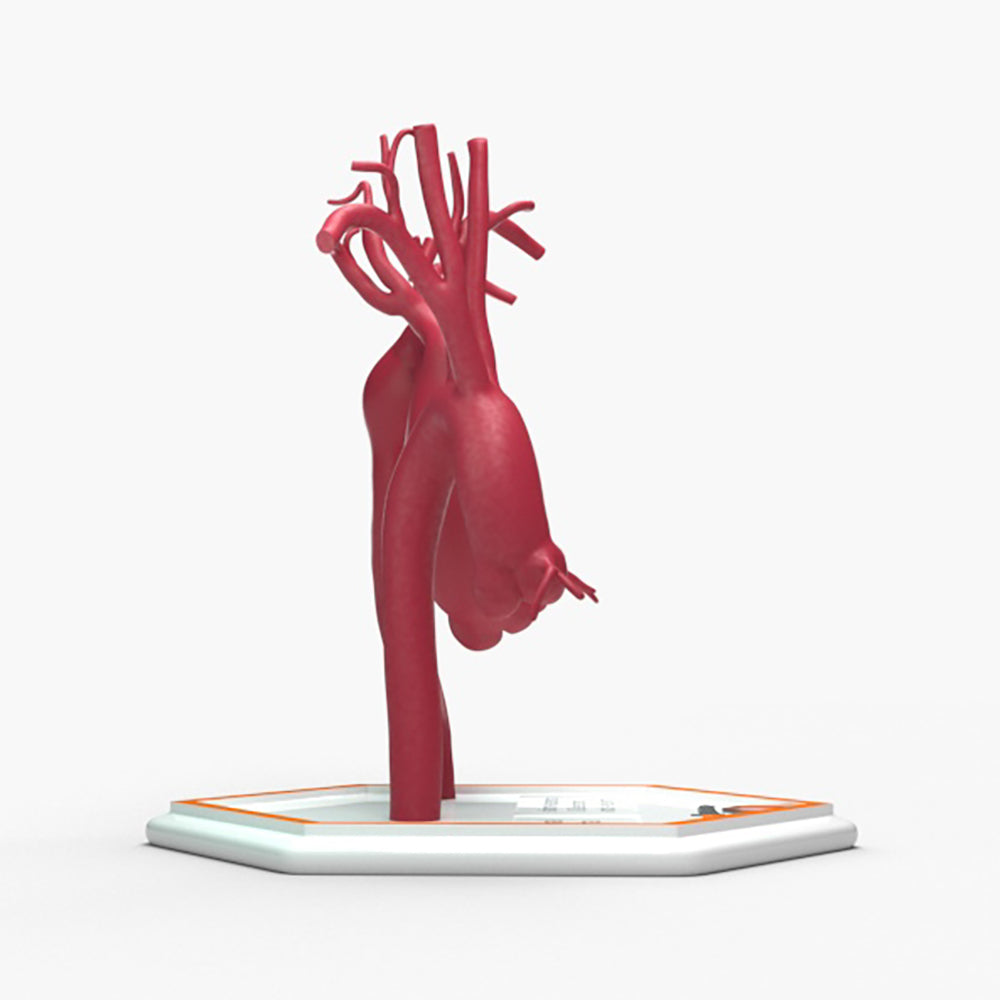 Fusiform Ascending & Descending Aortic Aneurysm 1 and Normal