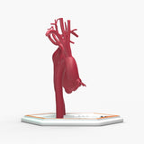 Fusiform Ascending & Descending Aortic Aneurysm 1 and Normal