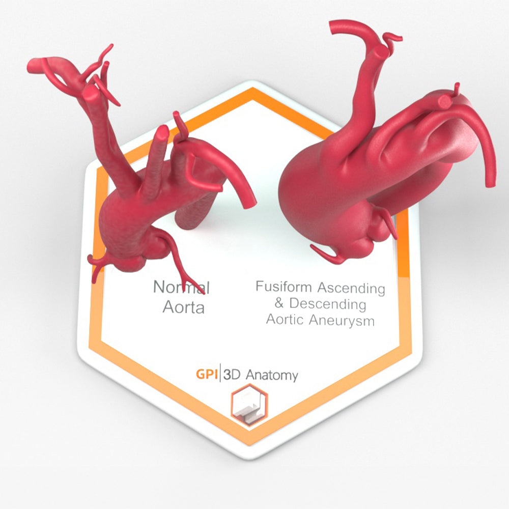 Fusiform Ascending & Descending Aortic Aneurysm 1 and Normal
