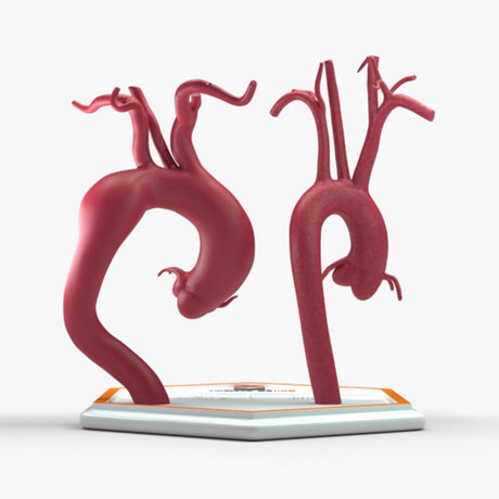 Fusiform Ascending & Descending Aortic Aneurysm 2 and Normal