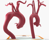 Fusiform Ascending & Descending Aortic Aneurysm 2 and Normal