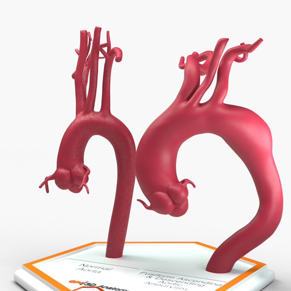 Fusiform Ascending & Descending Aortic Aneurysm 2 and Normal