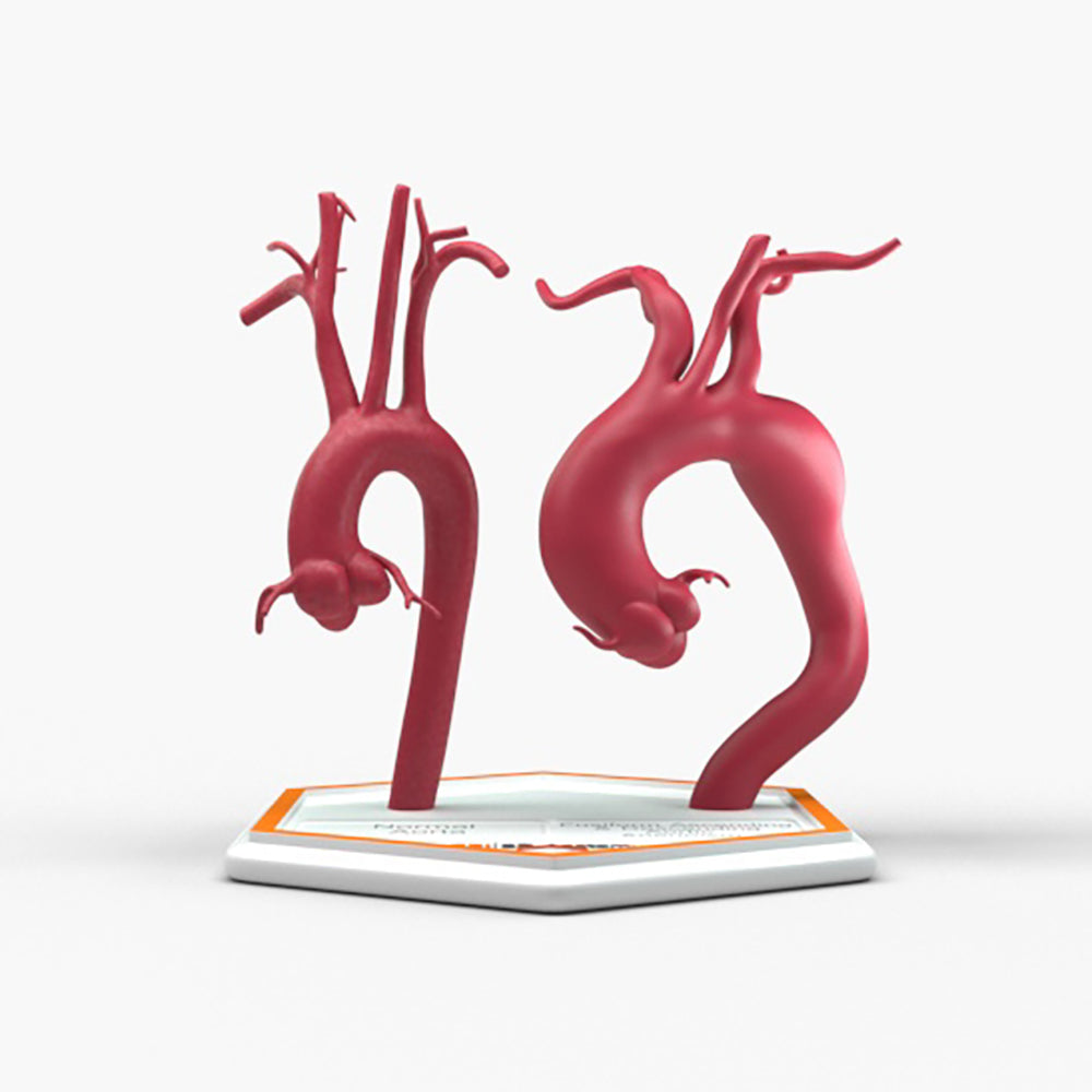Fusiform Ascending & Descending Aortic Aneurysm 2 and Normal