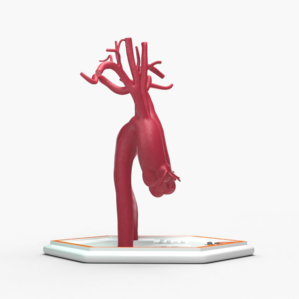 Fusiform Ascending & Descending Aortic Aneurysm 2 and Normal