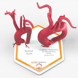 Fusiform Ascending & Descending Aortic Aneurysm 2 and Normal