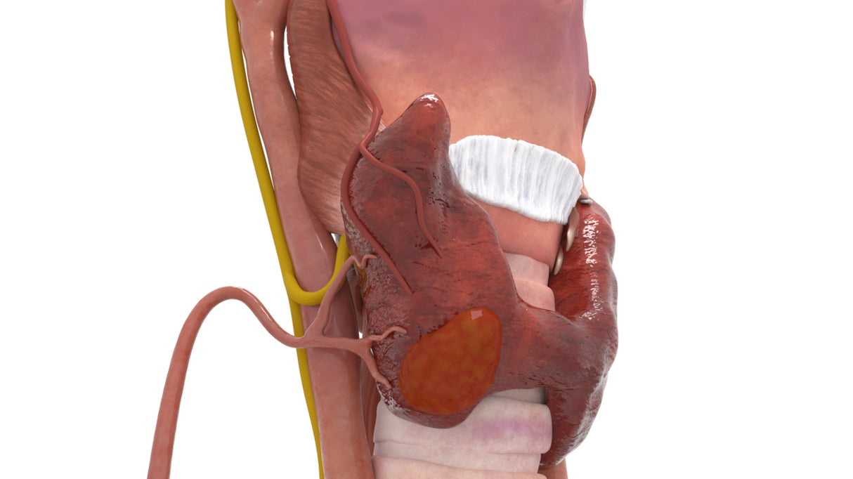 Aberrant Right Subclavian Non-Recurrent Laryngeal Nerve Right Thyroid Tumor