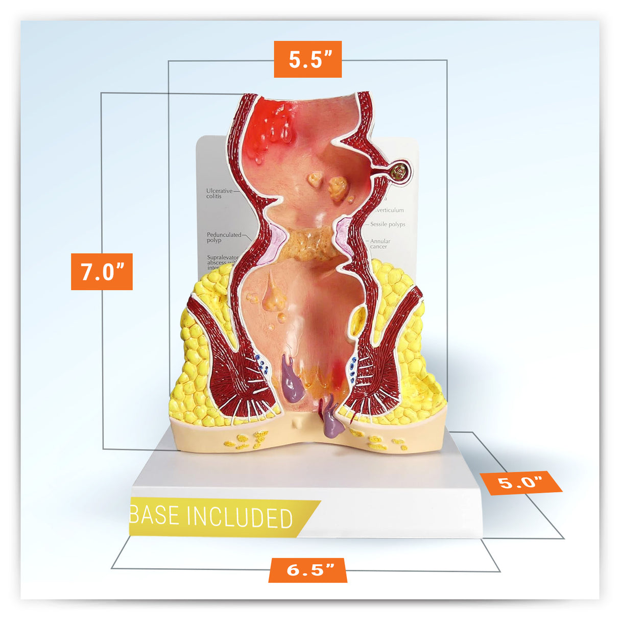 Rectum Model with Common Pathologies