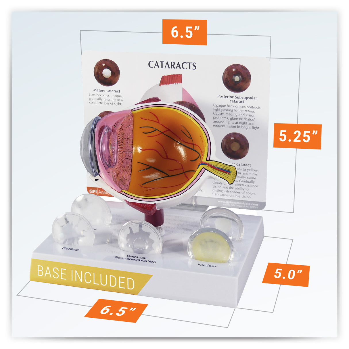 Cataract Eye Model