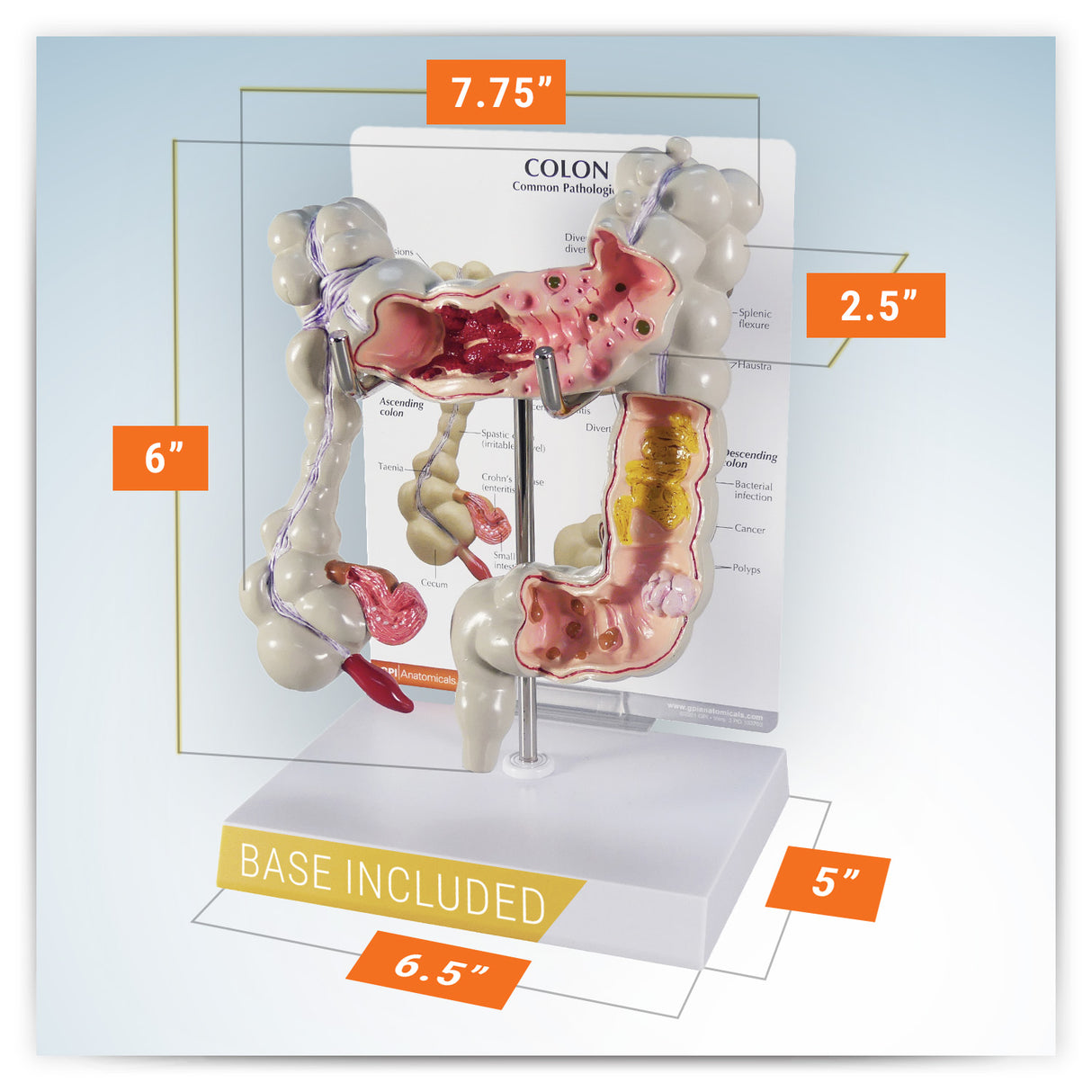 Colon Model with Common Pathologies