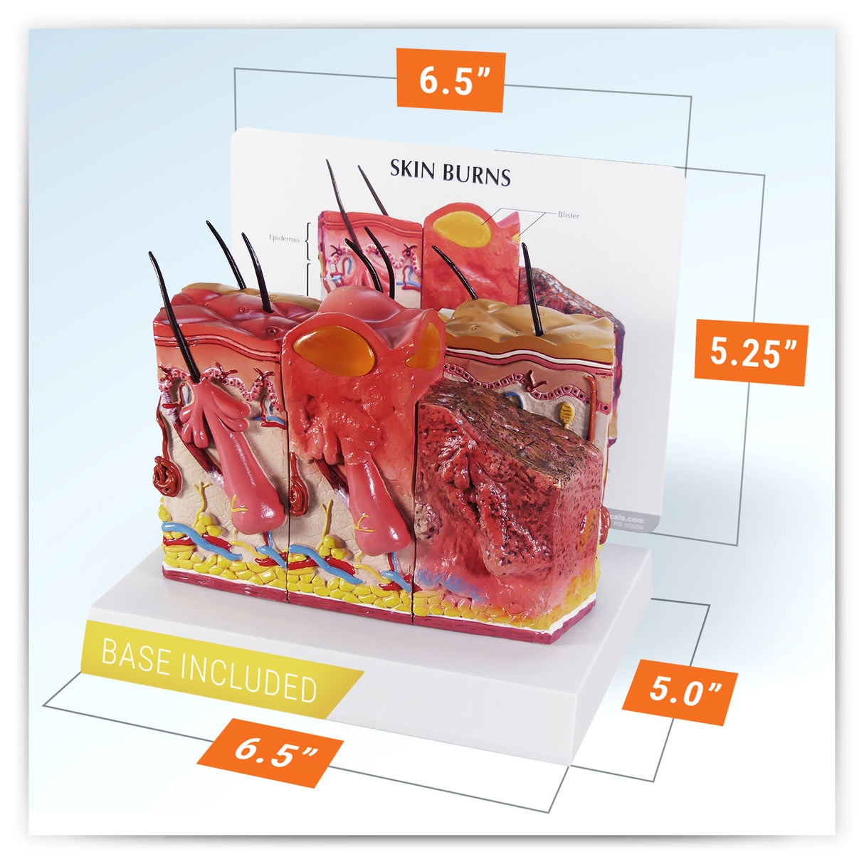 Skin Burn Model