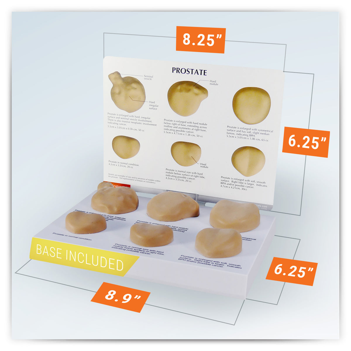 Prostate Scale Model Prostate with Conditions Model Set – GPI 3D Anatomy