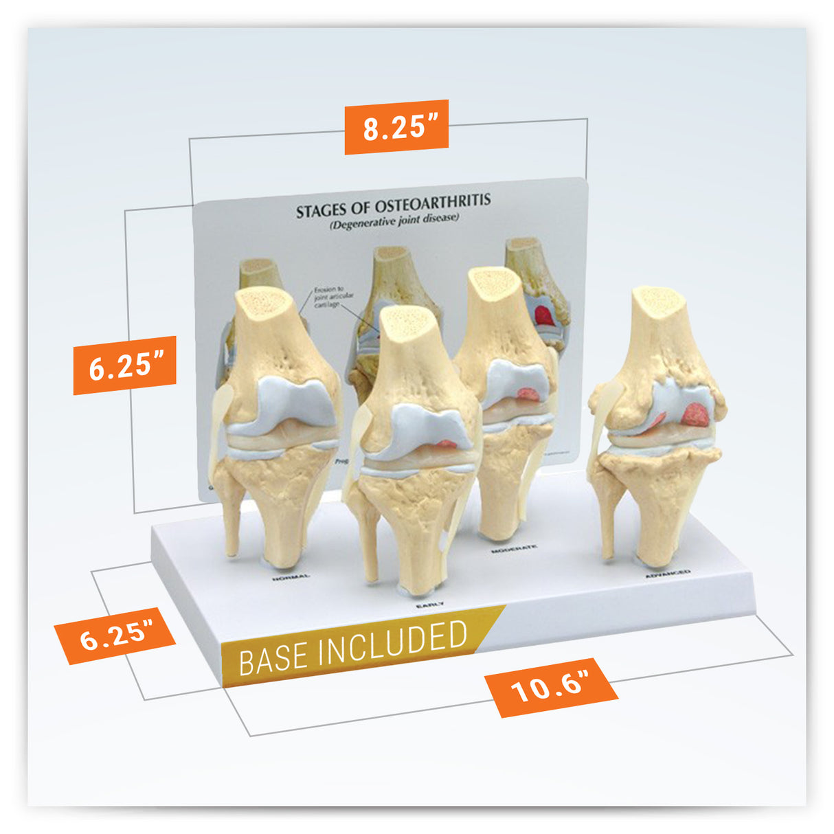 4-Stage Osteoarthritic Knee