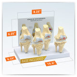 4-Stage Osteoarthritic Knee