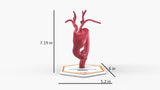 Aortic Arch - Fusiform Ascending Aneurysm