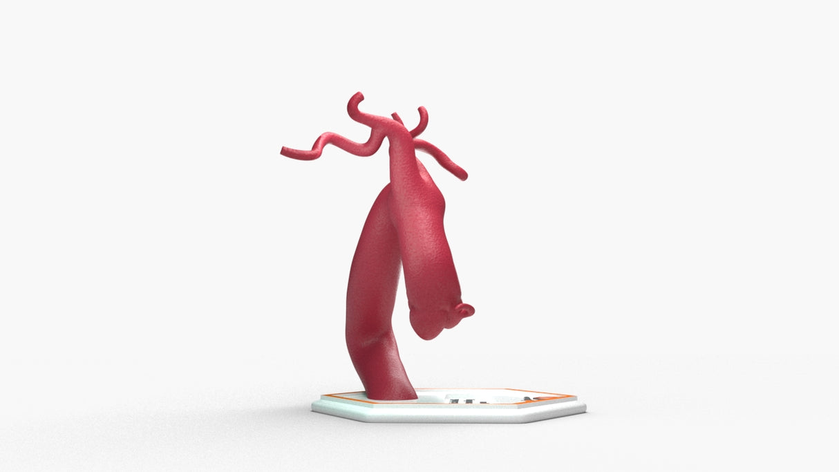 Aortic Arch - Fusiform with Proximal Descending Aneurysm