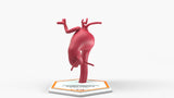 Aortic Arch - Fusiform Ascending Aneurysm