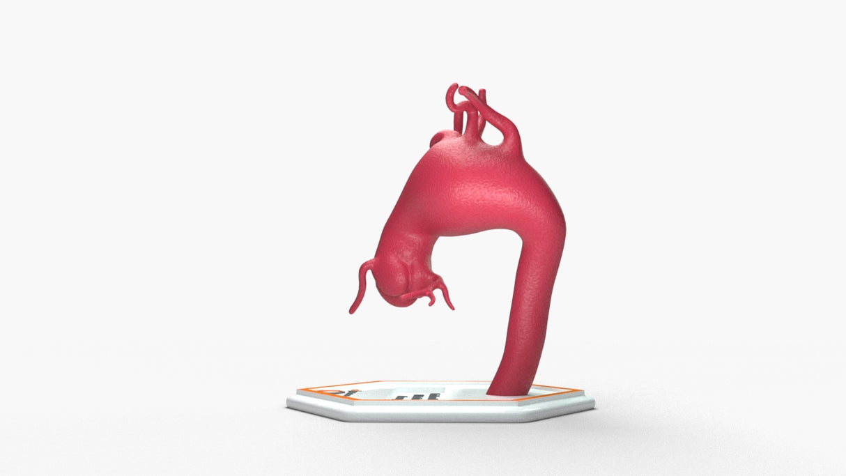 Aortic Arch - Fusiform Ascending Aneurysm