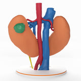 Horseshoe Kidney With Renal Cell Carcinoma (RCC) – Male, 41 Years