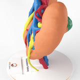 Horseshoe Kidney With Renal Cell Carcinoma (RCC) – Male, 41 Years