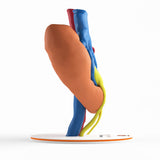 Horseshoe Kidney With Renal Cell Carcinoma (RCC) – Male, 41 Years