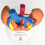 Horseshoe Kidney With Renal Cell Carcinoma (RCC) – Male, 41 Years