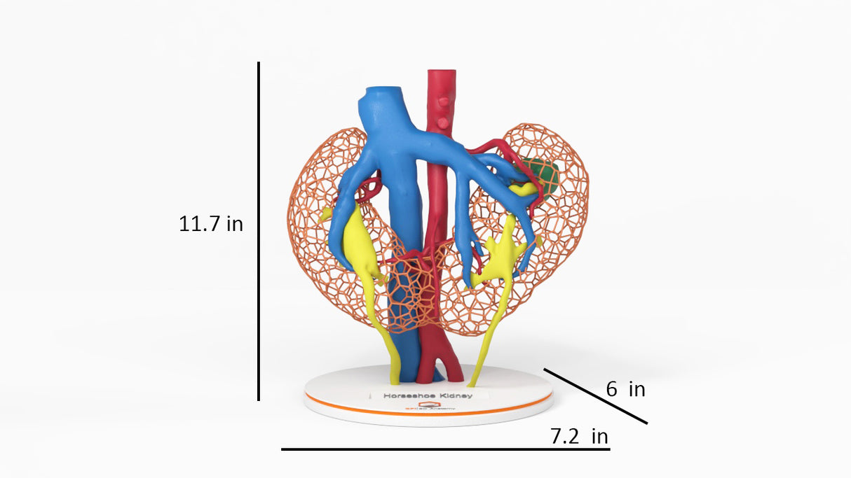 Lattice Horseshoe Kidney With Renal Cell Carcinoma (RCC) – Male, 41 Years