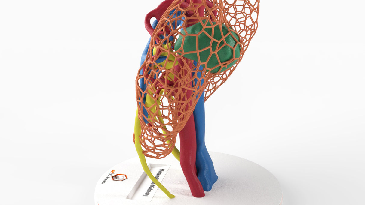 Lattice Horseshoe Kidney With Renal Cell Carcinoma (RCC) – Male, 41 Years