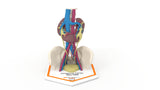 Horseshoe Kidney 19M