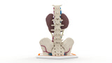 Horseshoe Kidney 19M