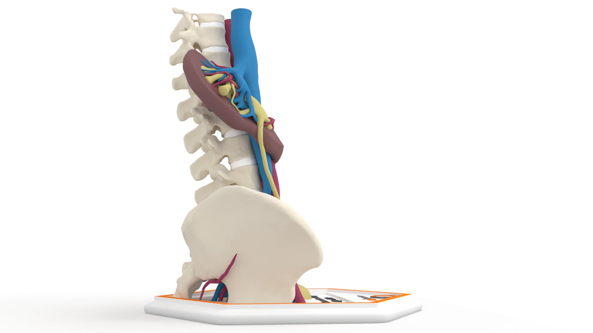 Horseshoe Kidney 19M