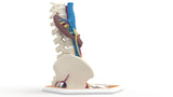 Horseshoe Kidney 19M